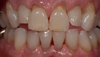 Comparison of a smile before and after porcelain veneers.
