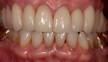 Close-up of a patient's smile after porcelain veneers treatment.