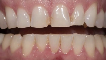 Before and after comparison of porcelain layered zirconia crowns.