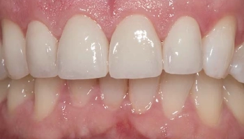 After image of a dental restoration with porcelain layered zirconia crowns.