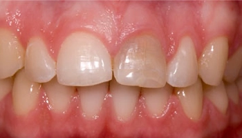 Before and after images of a porcelain dental crown.