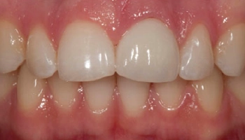Before and after images of a porcelain crown procedure.