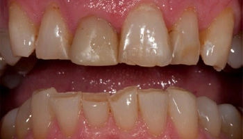 Before and after images of teeth with porcelain crowns.