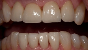 Transformed smile with new porcelain crowns after treatment.