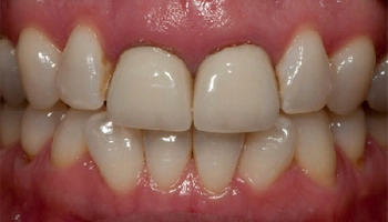 Before and after comparison of crown lengthening and porcelain crowns.