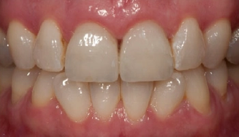 After image showing enhanced smile with porcelain crowns and gum contouring.
