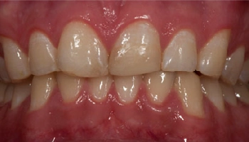 Before and after images of dental porcelain crowns.