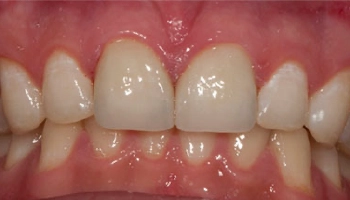 Patient's smile transformation with porcelain crowns after treatment.