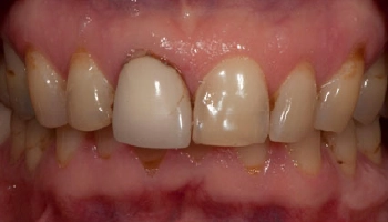 Before and after results of teeth bleaching and porcelain crowns.