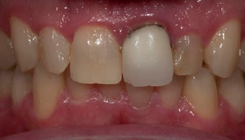 Before and after comparison of a smile enhanced by dental procedures.