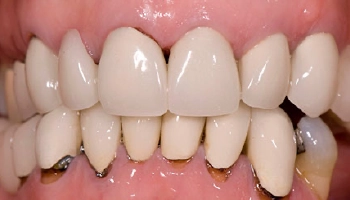 Before and after images of dental implants and crowns.