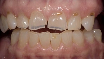 Before and after images of porcelain layered zirconia crowns.