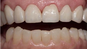 Before and after display of porcelain layered zirconia crowns.