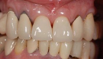 Before and after reconstructive dentistry with dental implants and crowns.