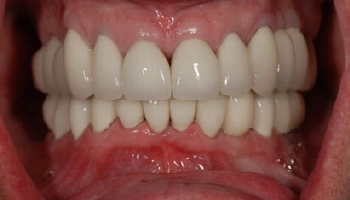 Before and after comparison of dental implants and crowns.