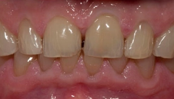 Transformative full mouth reconstruction showcasing improved dental aesthetics.