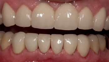 Transformed smile after full mouth reconstruction, showcasing enhanced dental aesthetics.