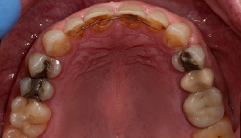 Before and after comparison of a full mouth reconstruction.