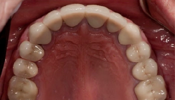 Smiling patient showcasing improved dental alignment post-reconstruction.
