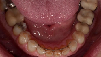 After image of a transformed smile post full mouth reconstruction.