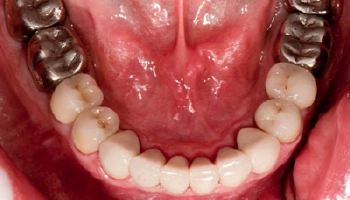 Transformed smile after full mouth reconstruction dental treatment.