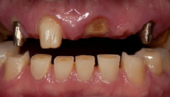 Before and after comparison of dentures and dental crowns.