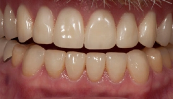 Before and after comparison of lower crowns and denture restoration.
