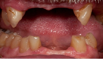 Before and after images of reconstructive dentistry with crowns and dentures.