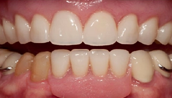 Before-and-after comparison of a dental crown restoration.