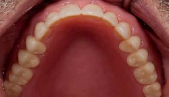 Before and after images of dentures and crowns restoration.