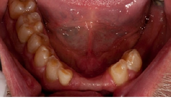 Before and after images of dental crowns and partial dentures.