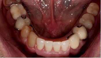 Before and after image of dental crowns and dentures.