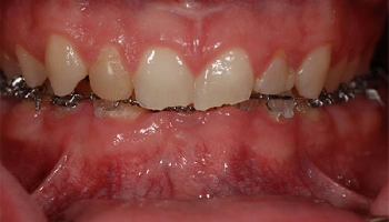 Before and after images of a smile transformation with dental procedures.