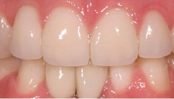After image showing enhanced smile with orthodontics and veneers.