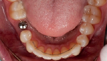 Before/after comparison of a porcelain implant crown restoration.