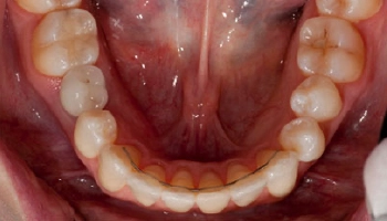 Close-up of a porcelain implant crown after placement.