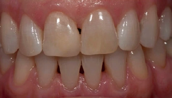 After image of improved dental composite bonding.