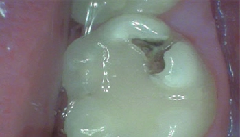 Before and after views of composite bonding on a tooth.
