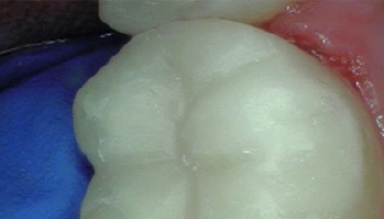 After image of a tooth with composite filling restoration.