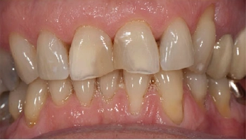Before and after images of composite crown dental work.