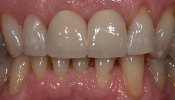 After view of a smile with composite crowns.