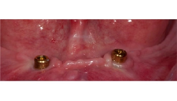 Before and after photos of an implant retained lower denture.