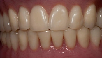 Comparison of lower denture before and after implant retention.