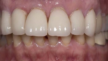 Before and after comparison of porcelain layered zirconia crowns.