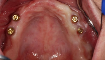Before image of a maxillary denture, showing missing teeth.