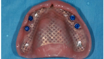 After image of a maxillary denture supported by four implants.
