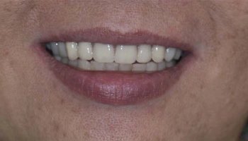 Before and after images of a maxillary denture with implants.