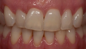 Before and after results of chairside teeth bleaching treatment.
