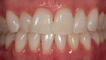 After chairside bleaching, noticeably whiter teeth.