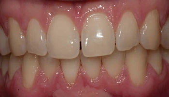 Before and after images of teeth whitening results.